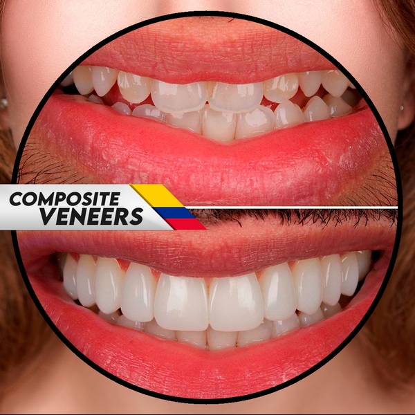 You are currently viewing Dental Implants in Colombia: Prices, Clinics, and Complete Guide