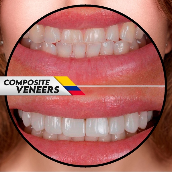 You are currently viewing The Ultimate Guide to Teeth Whitening in Medellín, Colombia: Professional Options & Results