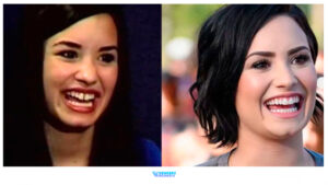 40 Celebrities With Veneers, Before & After Transformations + Costs
