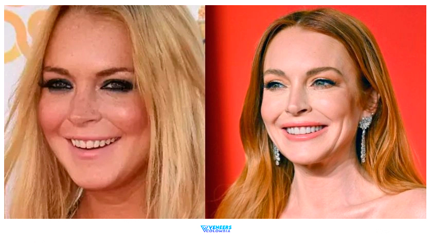 You are currently viewing 40 Celebrities With Veneers, Before & After Transformations + Costs & Trends