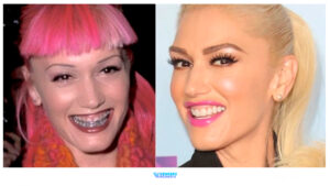 40 Celebrities With Veneers, Before & After Transformations + Costs