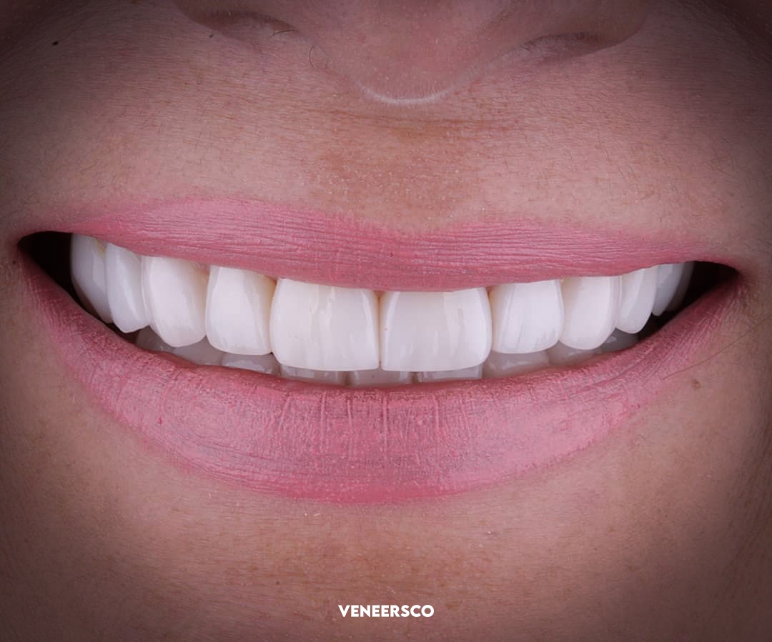 Before: minor gaps and discoloration. After: perfectly aligned smile.