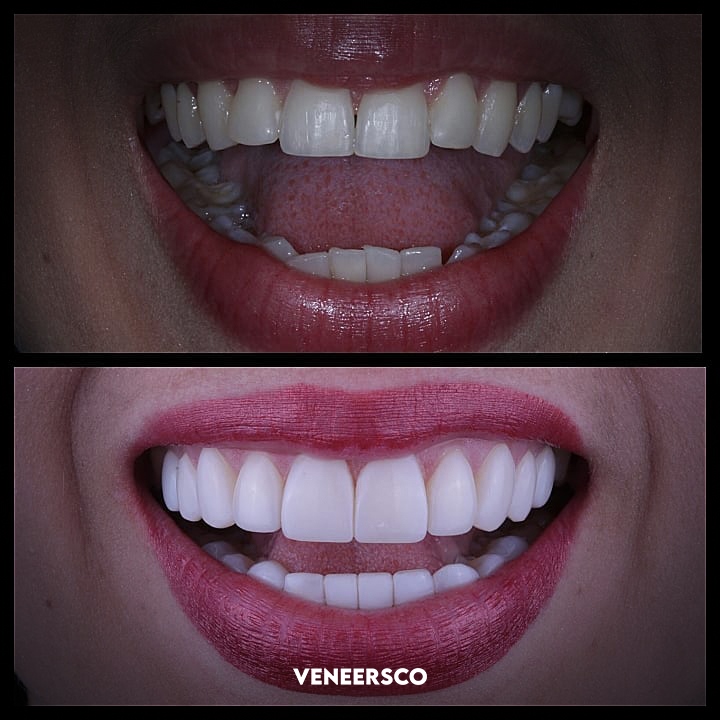 Before: worn and dull teeth. After: bright and symmetrical smile.