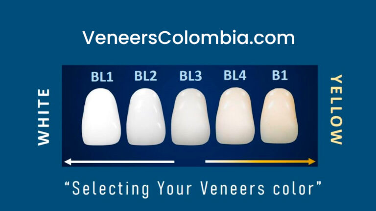 Read more about the article The Ultimate Veneer Color Shades Guide: Is BL2 Too White for You?