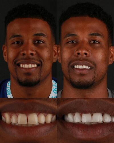 afro american with porcelain veneers, before and after