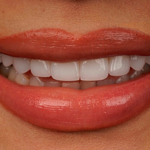 Close-up of a bright, even smile with porcelain veneers and glossy red lips, showcasing natural tooth texture and perfect alignment