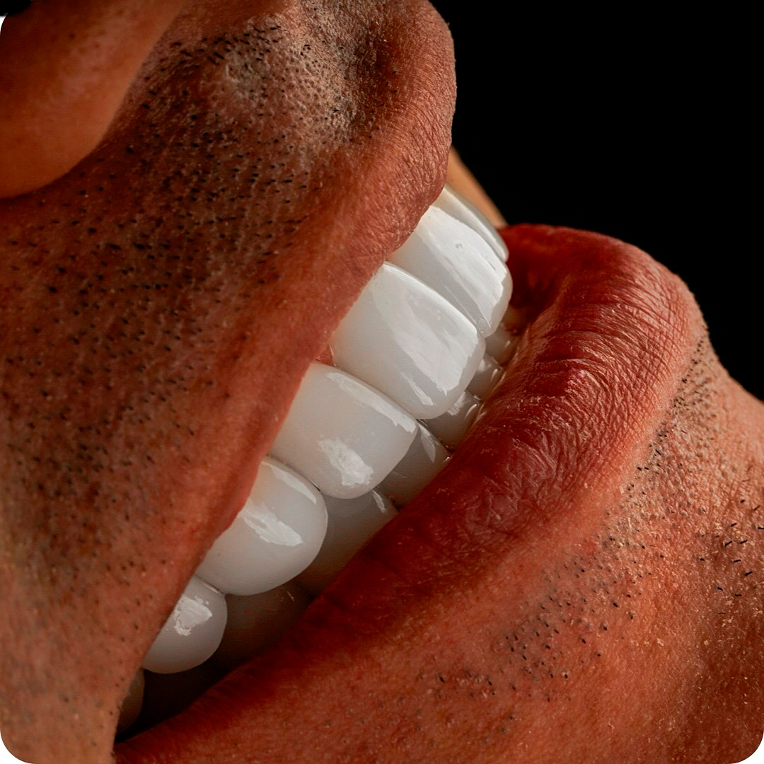 Close-up side view of a man's smile with perfectly aligned and polished porcelain veneers, showing natural gum line and facial stubble