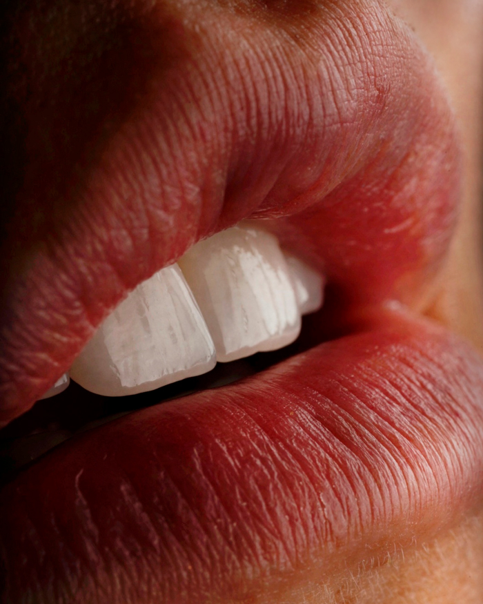 You are currently viewing E.max Veneers in Colombia: Premium Quality in Just 2 Days