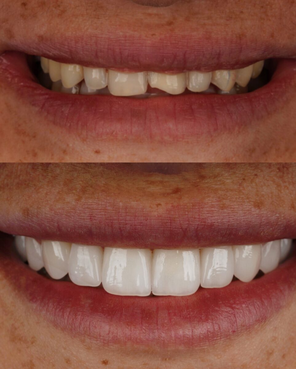 Before and after comparison of a smile showing natural teeth with discoloration and unevenness, followed by a bright, symmetrical smile after getting porcelain veneers