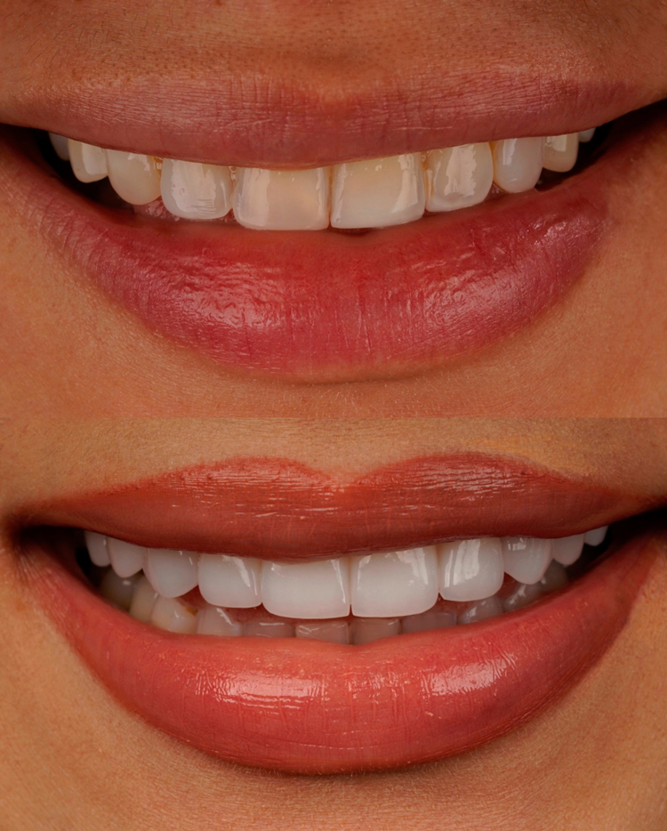 Close-up before and after image of a smile transformation using porcelain veneers, showing stained and uneven teeth corrected to a whiter, symmetrical, and natural-looking result