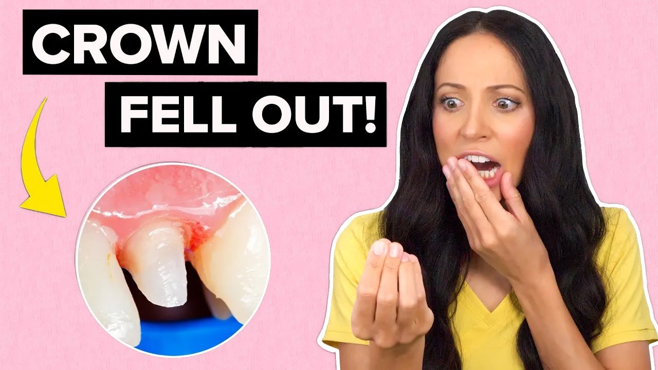 You are currently viewing What to Do If Your Dental Crown Falls Out: A Step-by-Step Guide