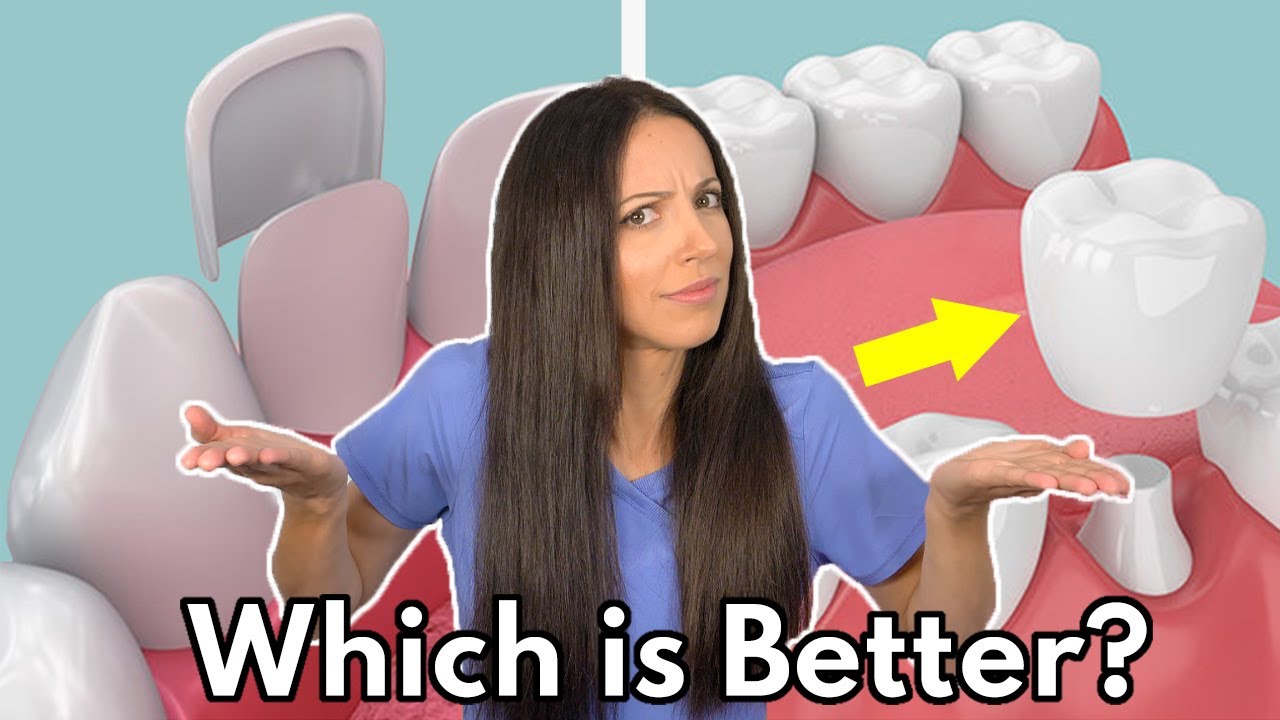 You are currently viewing Veneers vs. Crowns: Key Differences, Benefits, and What to Choose