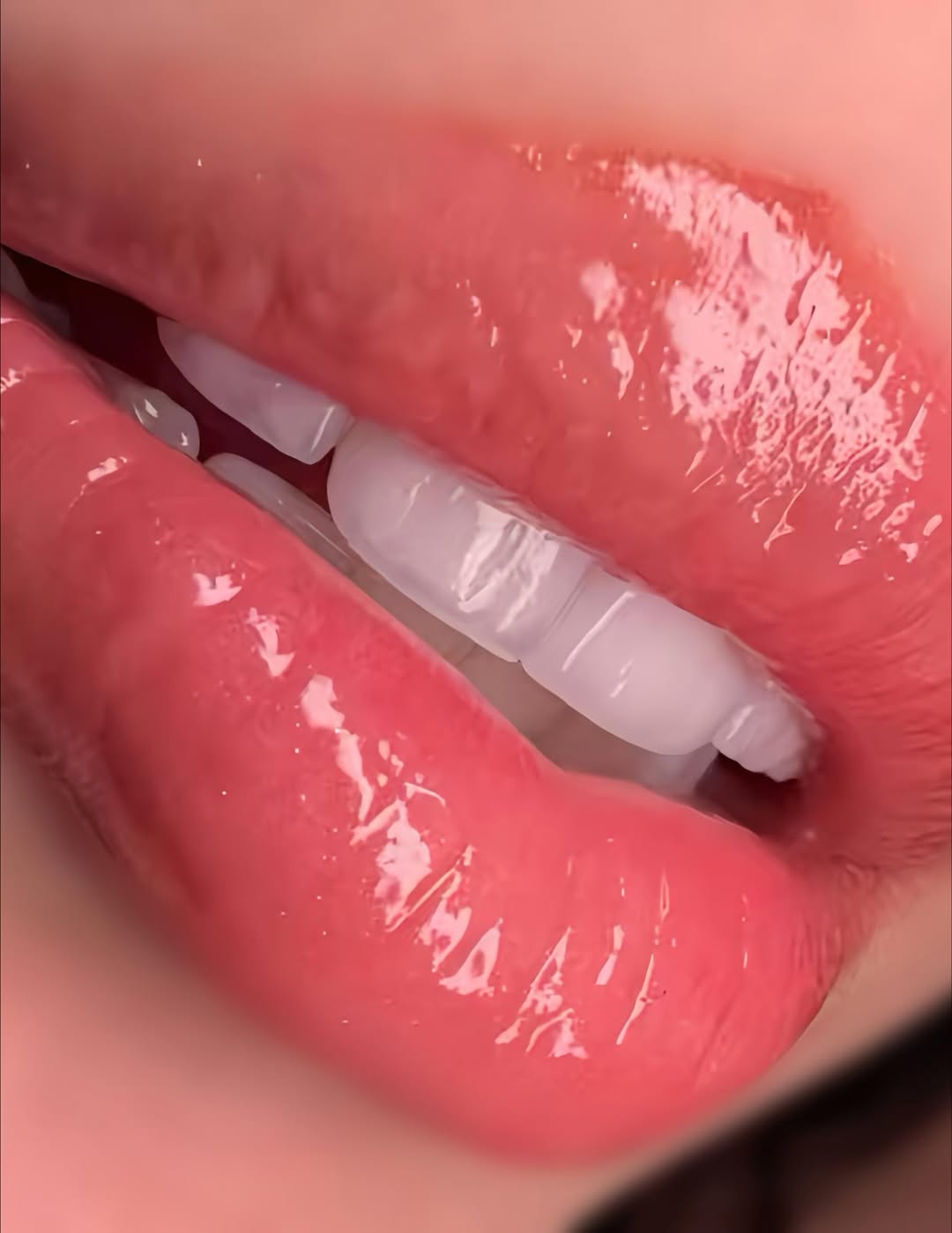 You are currently viewing What Are Veneers Teeth? The Ultimate Guide to Dental Veneers — and Is This Procedure Right for You?