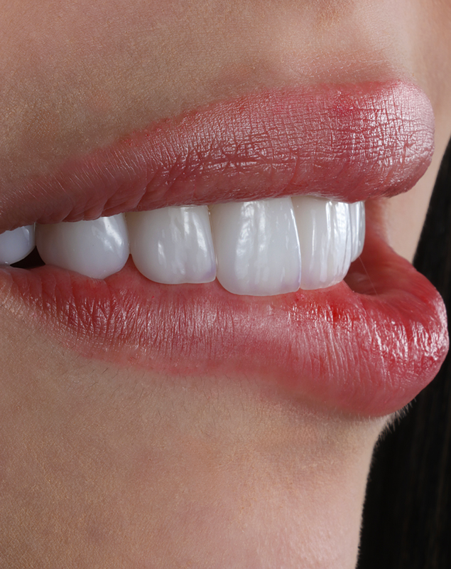 You are currently viewing Veneers in Medellín: 2025 Costs, 2‑Day Full Smile Options & Best Clinics