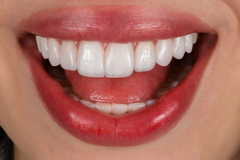 Read more about the article The Ultimate Guide to the Cheapest Countries for Dental Veneers in 2025