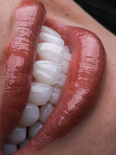 Ultra thin emax porcelain veneers Medellin Colombia close-up