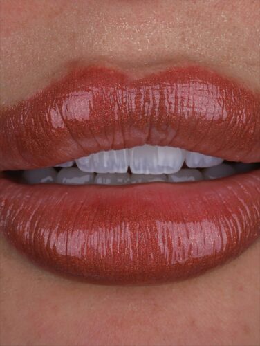 Perfect smile makeover with porcelain veneers in Medellin Colombia