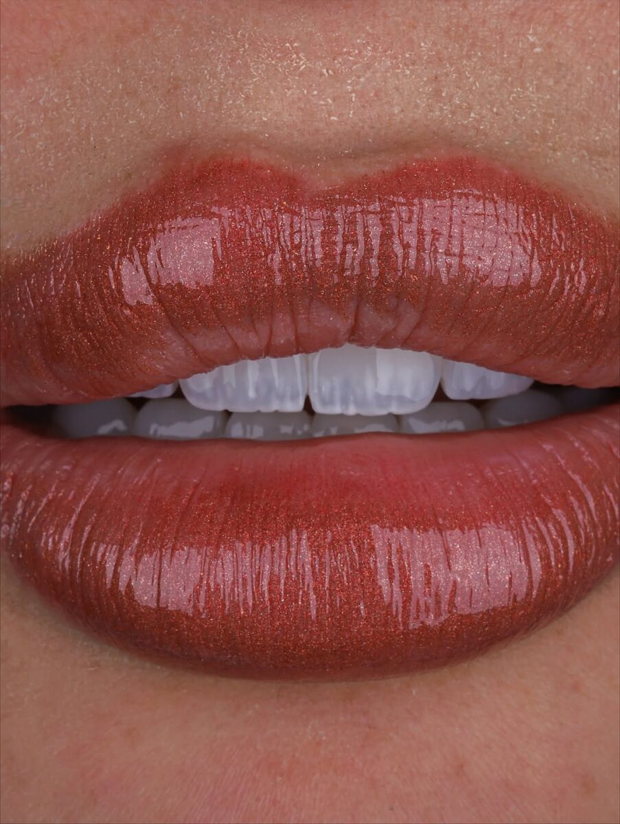 Perfect smile makeover with porcelain veneers in Medellin Colombia