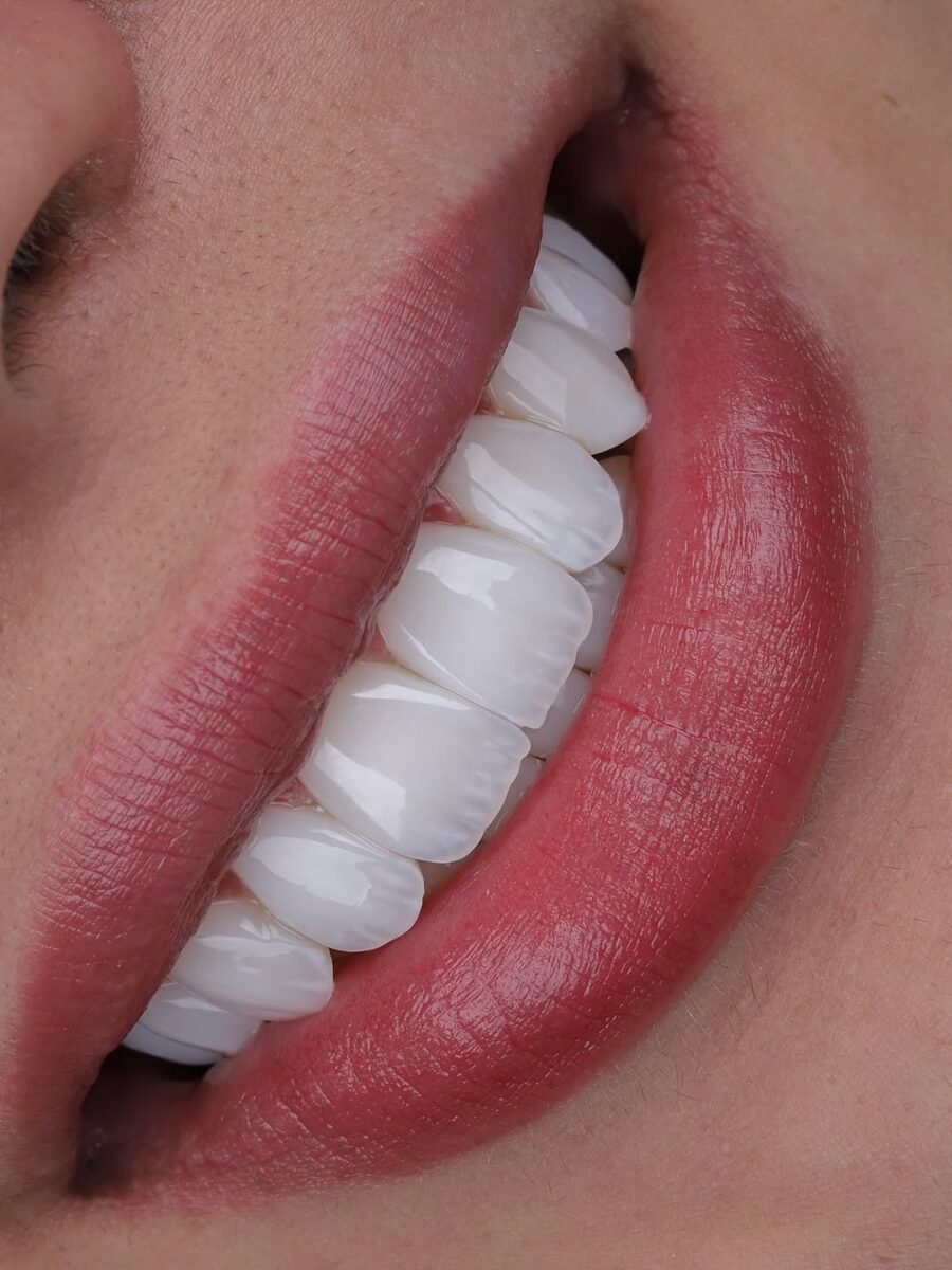 Emax veneers Colombia natural shade close-up