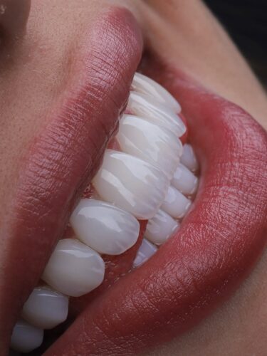 Natural looking porcelain veneers in Colombia close-up