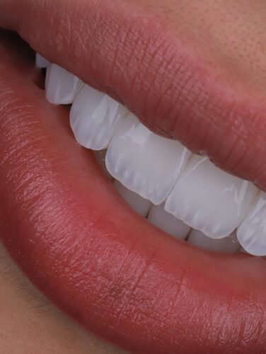 Dental tourism Colombia porcelain veneers natural smile close-up