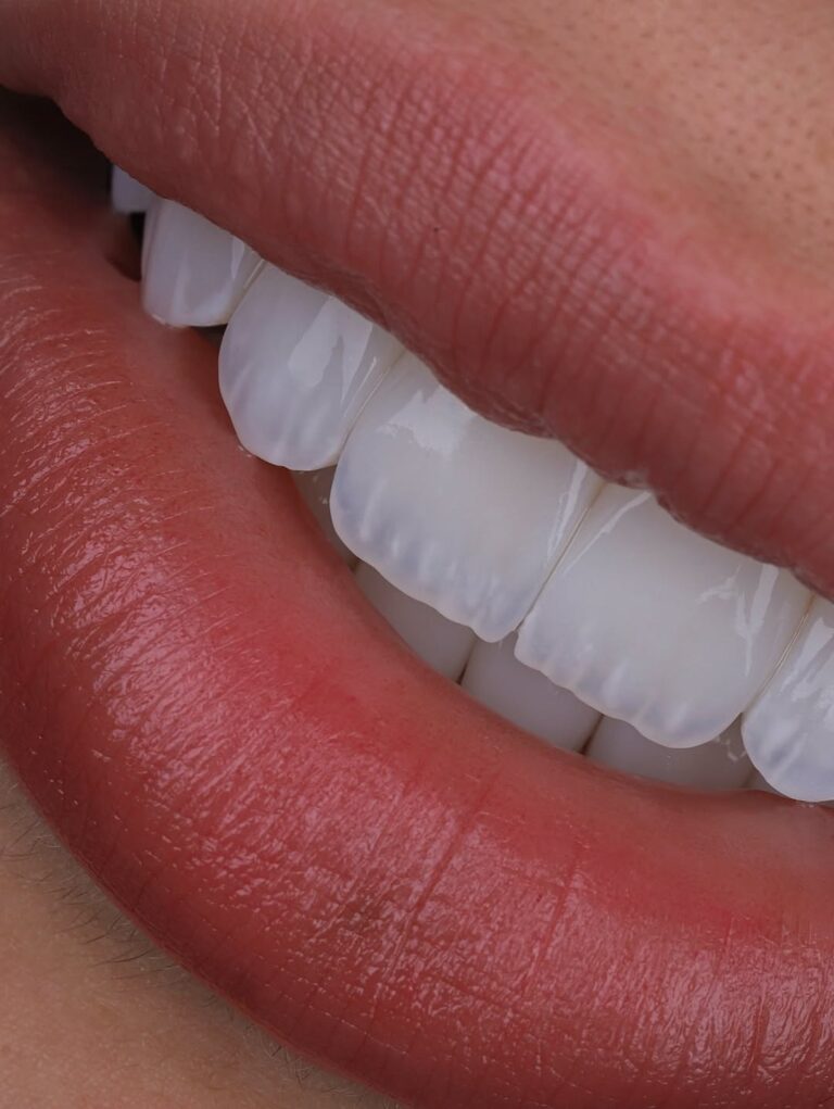 Dental tourism Colombia porcelain veneers natural smile close-up