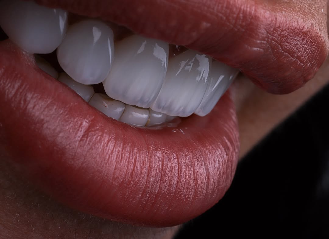 Close-up of porcelain veneers in Medellin Colombia showing natural emax dental work