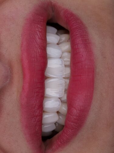 Emax porcelain veneers in Colombia with ultra white smile close-up