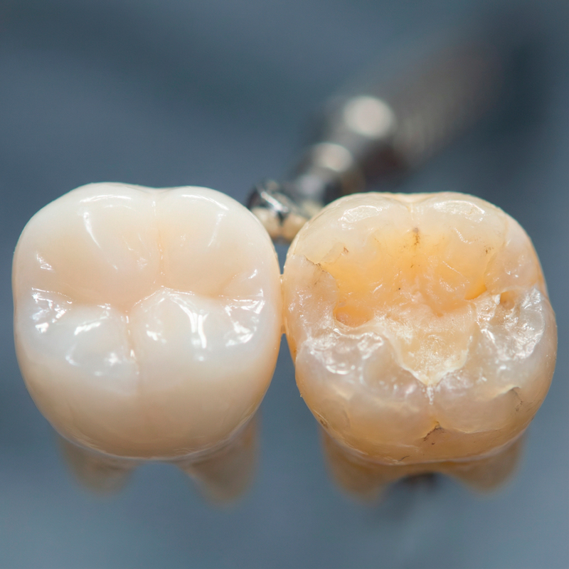 Close-up of enamel removal on a molar tooth showing the difference between natural tooth structure and a prepared tooth for porcelain veneer or dental crown in Colombia