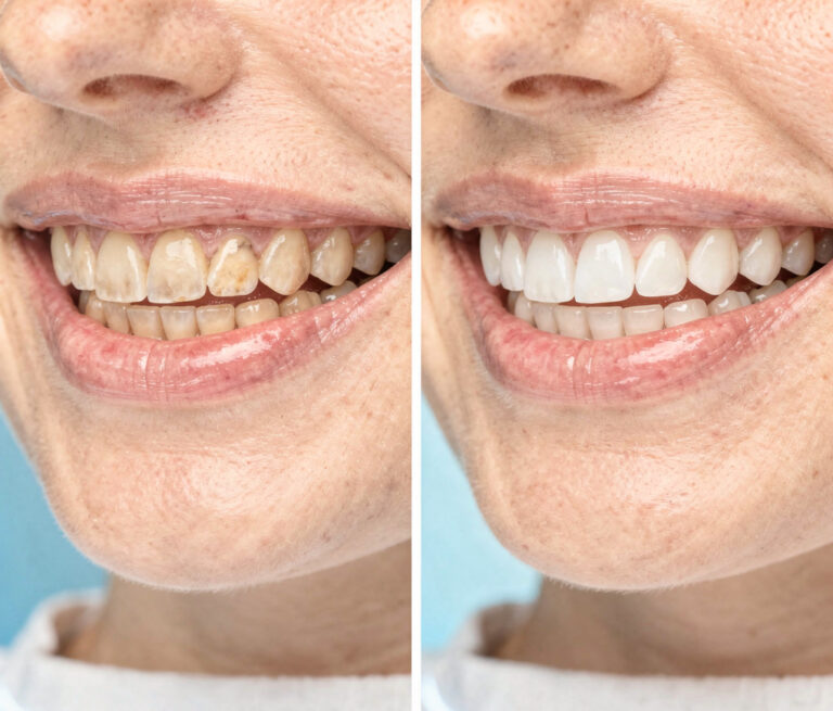 Read more about the article What Are Veneers? The Complete Guide to Dental Veneers, Types, Costs, and Benefits