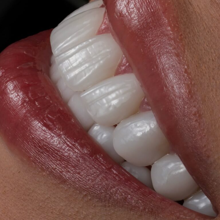 Read more about the article The Premium Veneer Materials Used by Colombia’s Elite Cosmetic Dentists