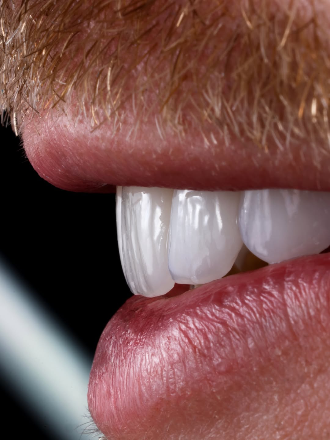 Close-up of natural-looking E-max porcelain veneers by Dr. Yazmín Escudero in Medellín