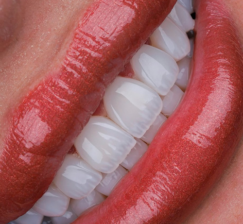 Emax HD Porcelain veneers with translucent edge stratification