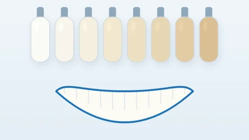 What shade are my teeth: illustration of dental shade guide tabs from lightest to darker next to a smile outline